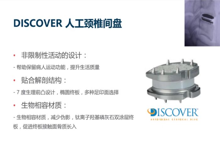  DISCOVER人工颈椎间盘