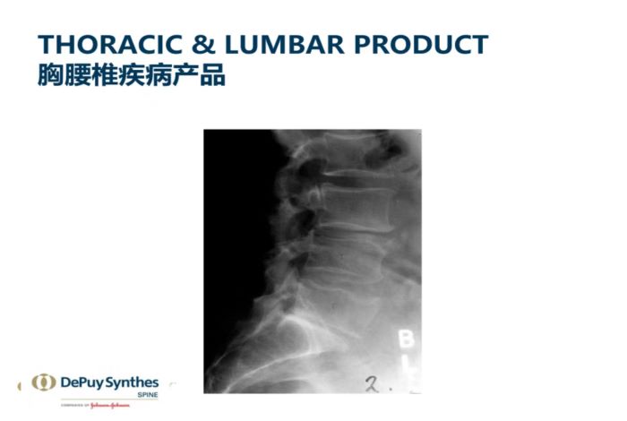  THORACIC&LUMBAR PRODUCT胸腰椎疾病产品